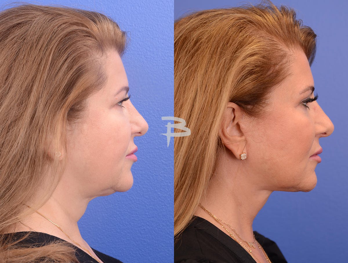 Buccal Fat Removal Before & After Gallery - Patient 202278 - Image 3