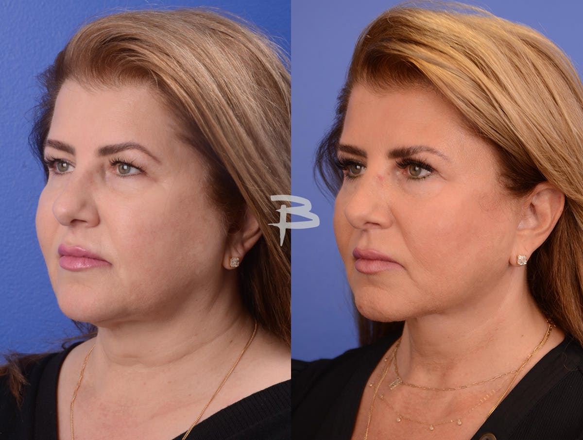 Buccal Fat Removal Before & After Gallery - Patient 202278 - Image 4