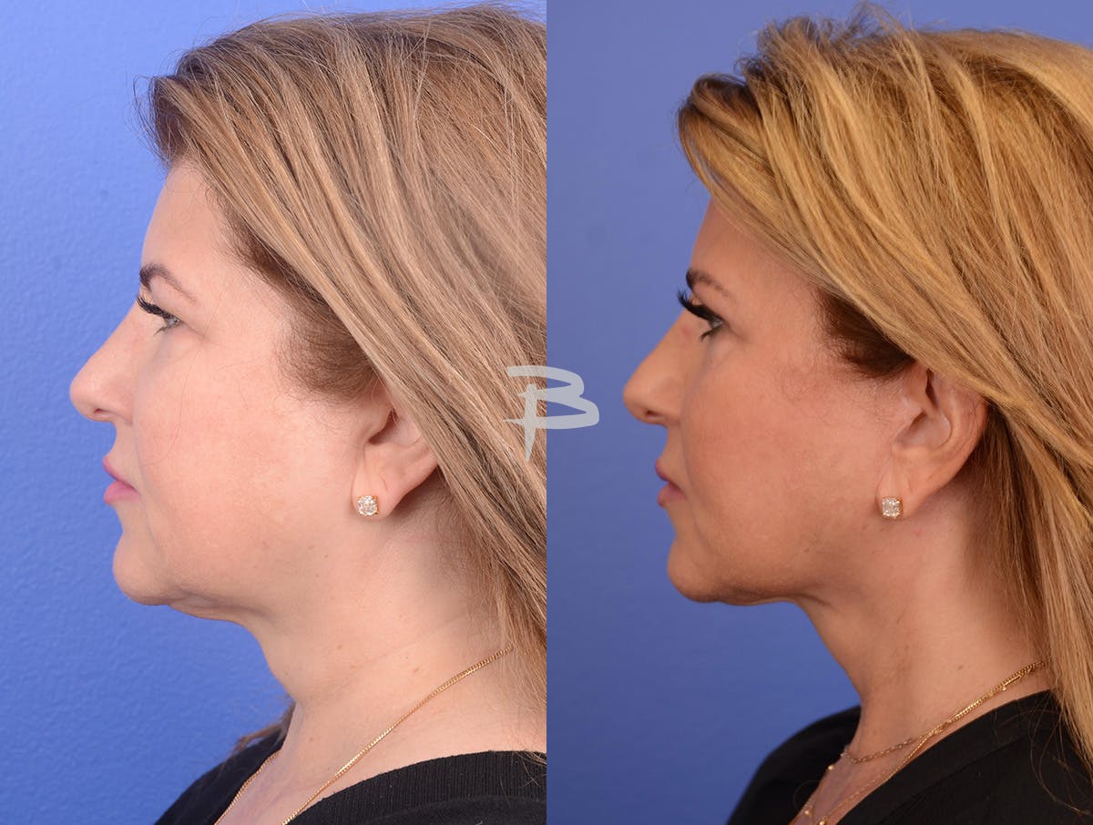 Buccal Fat Removal Before & After Gallery - Patient 202278 - Image 5