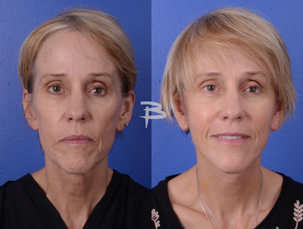 Facelift Before & After Gallery - Patient 282777 - Image 1