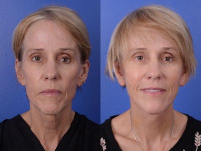 Facelift Before & After Gallery - Patient 282777 - Image 1