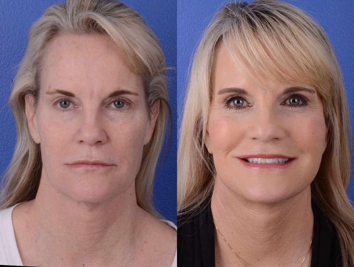 Facelift Before & After Gallery - Patient 243055 - Image 1