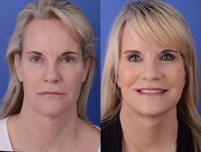 Facelift Before & After Gallery - Patient 243055 - Image 1