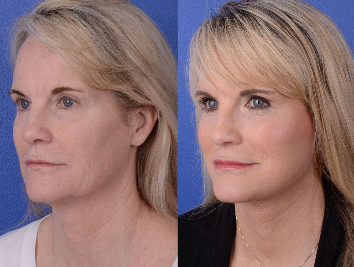 Facelift Before & After Gallery - Patient 243055 - Image 2