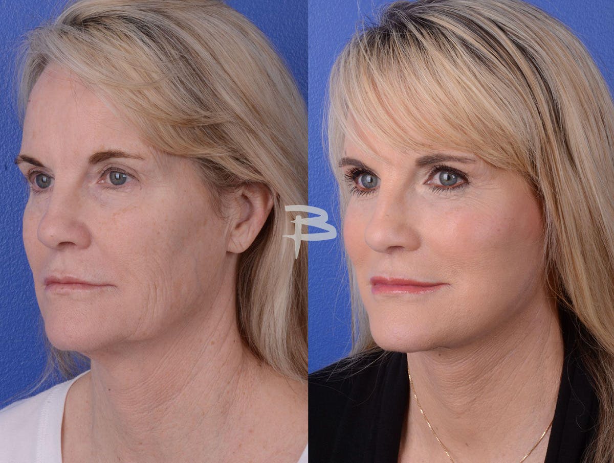 Facelift Before & After Gallery - Patient 243055 - Image 2