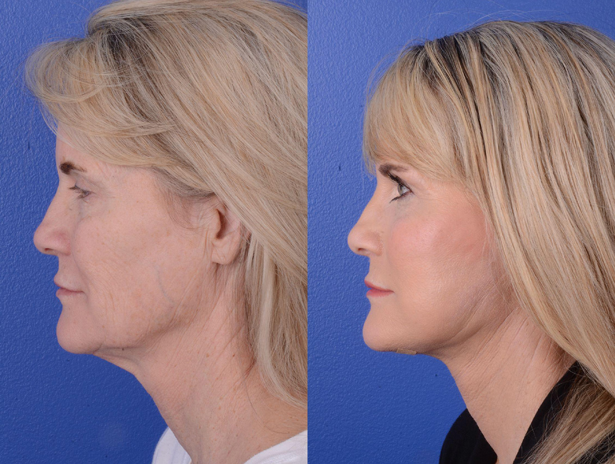 Facelift Before & After Gallery - Patient 243055 - Image 3