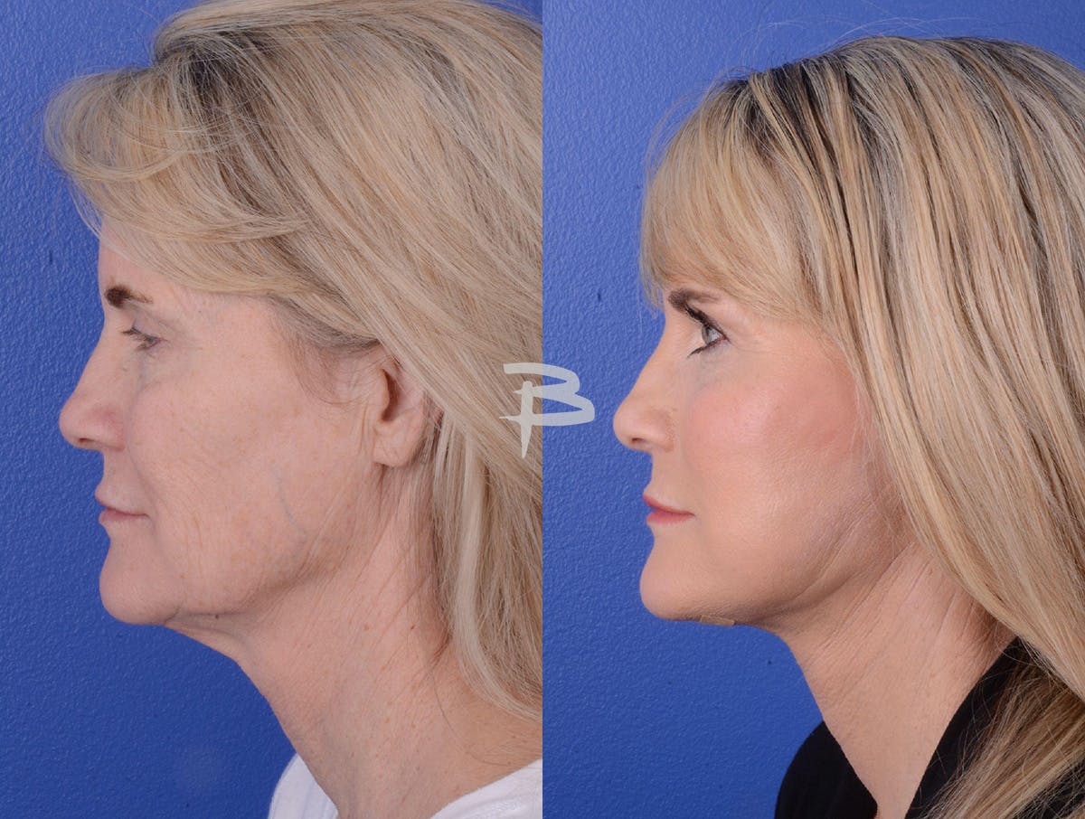 Facelift Before & After Gallery - Patient 243055 - Image 3