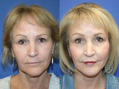Facelift Before & After Gallery - Patient 414857 - Image 1