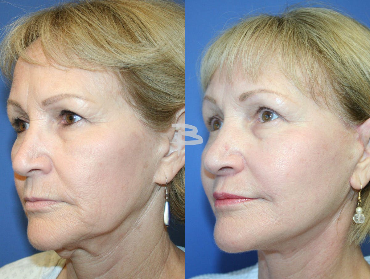 Facelift Before & After Gallery - Patient 414857 - Image 2