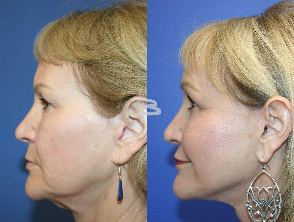 Facelift Before & After Gallery - Patient 414857 - Image 3