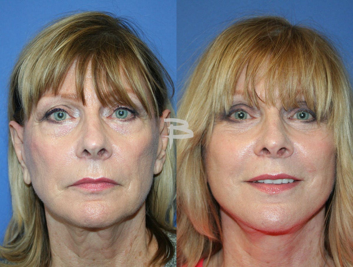 Facelift Before & After Gallery - Patient 420306 - Image 1