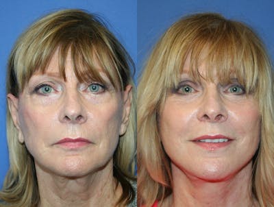 Facelift Before & After Gallery - Patient 420306 - Image 1