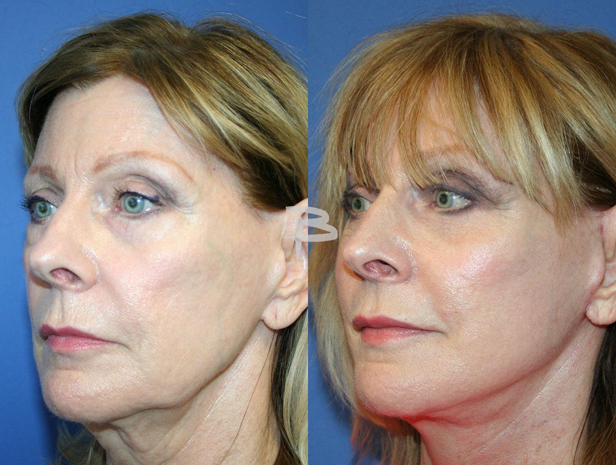 Facelift Before & After Gallery - Patient 420306 - Image 2