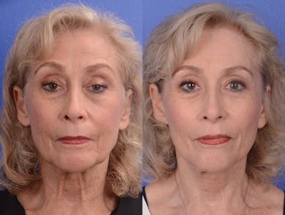 Facelift Before & After Gallery - Patient 265881 - Image 1