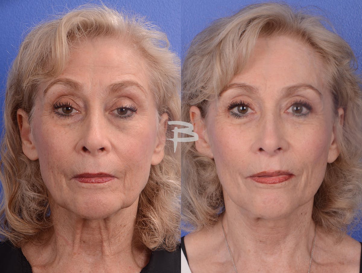 Facelift Before & After Gallery - Patient 265881 - Image 1