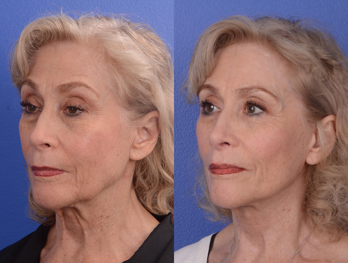 Facelift Before & After Gallery - Patient 265881 - Image 2