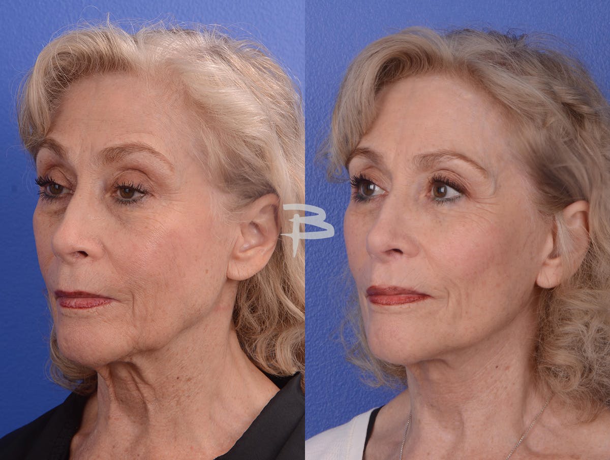 Facelift Before & After Gallery - Patient 265881 - Image 2