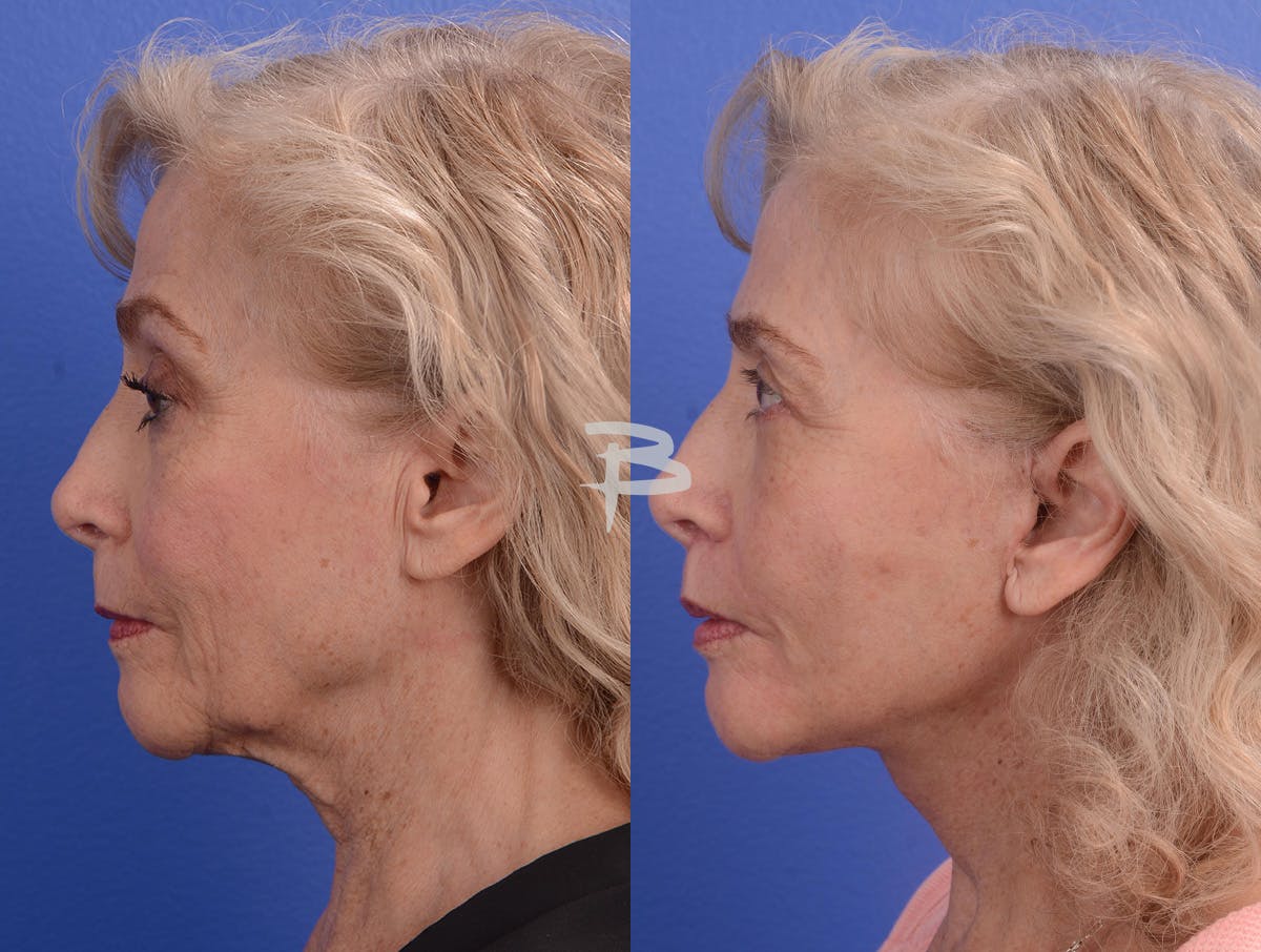 Facelift Before & After Gallery - Patient 265881 - Image 3
