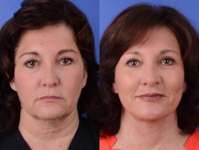 Facelift Before & After Gallery - Patient 211751 - Image 1