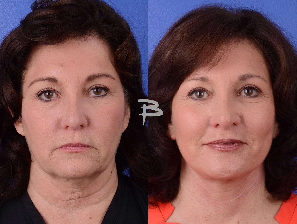 Facelift Before & After Gallery - Patient 211751 - Image 1