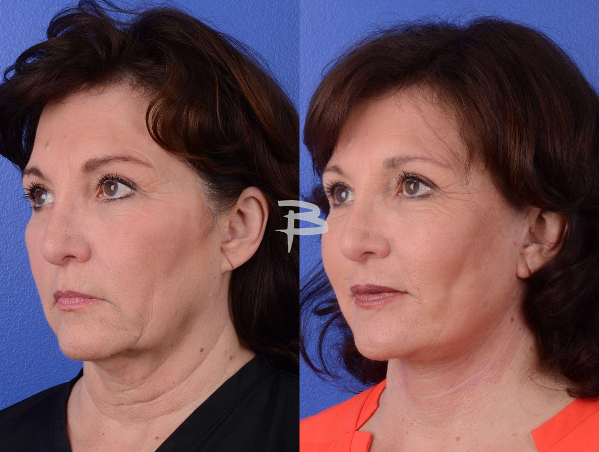 Facelift Before & After Gallery - Patient 211751 - Image 2