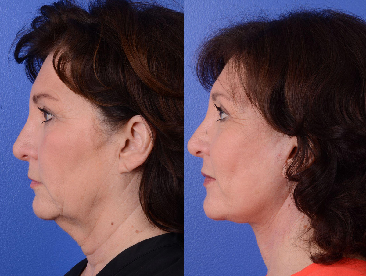 Facelift Before & After Gallery - Patient 211751 - Image 3