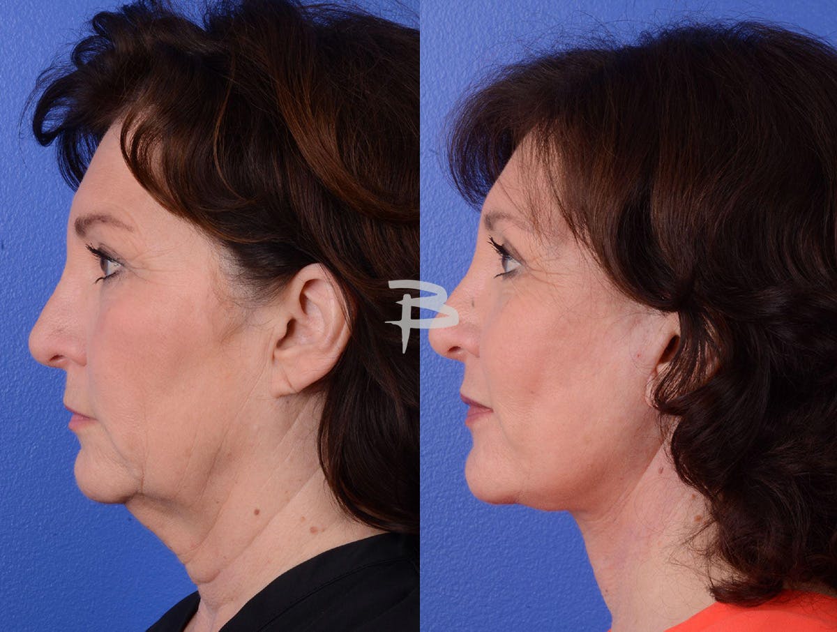 Facelift Before & After Gallery - Patient 211751 - Image 3