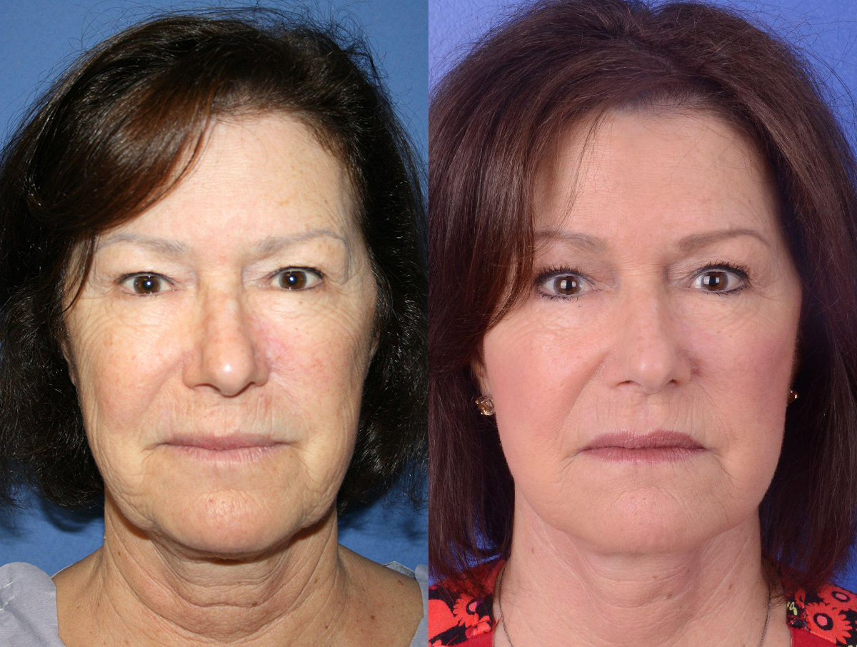 Facelift Before & After Gallery - Patient 118800 - Image 1