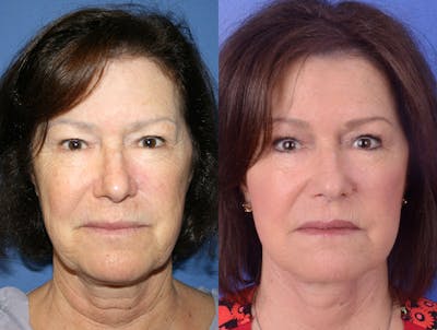 Facelift Before & After Gallery - Patient 118800 - Image 1