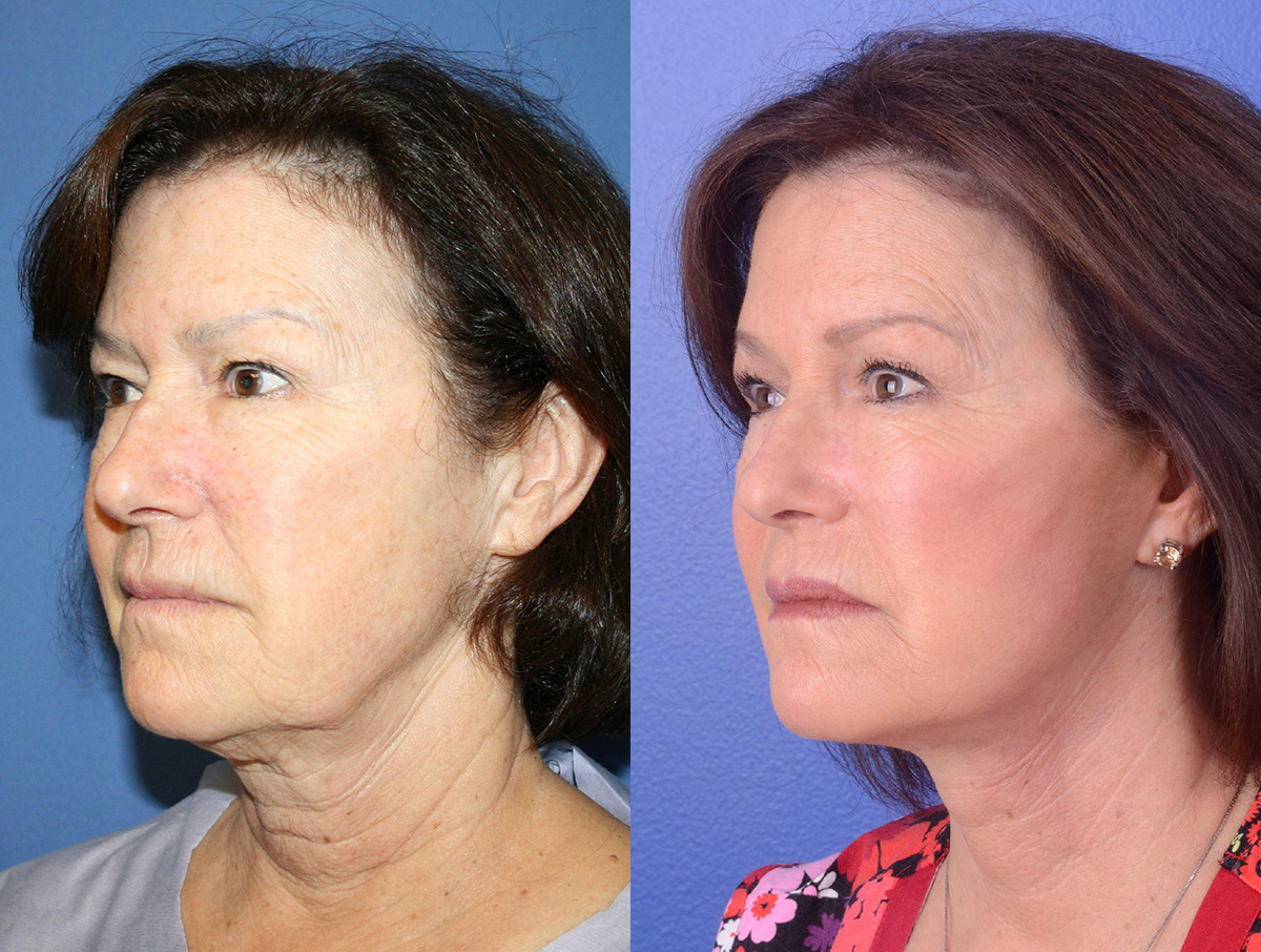 Facelift Before & After Gallery - Patient 118800 - Image 2