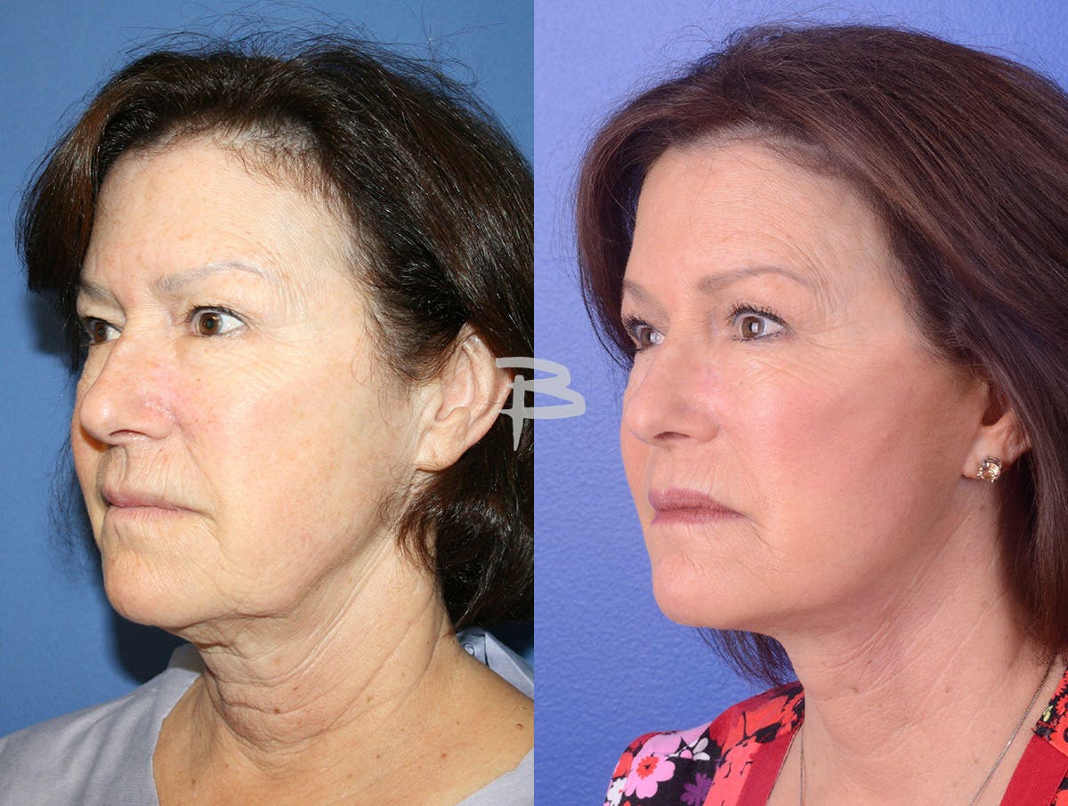 Facelift Before & After Gallery - Patient 118800 - Image 2