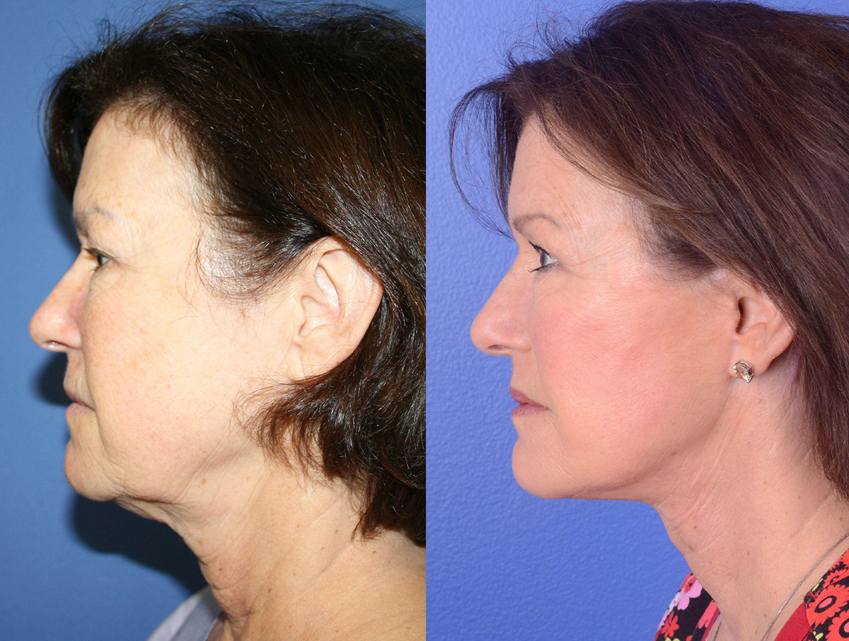 Facelift Before & After Gallery - Patient 118800 - Image 3