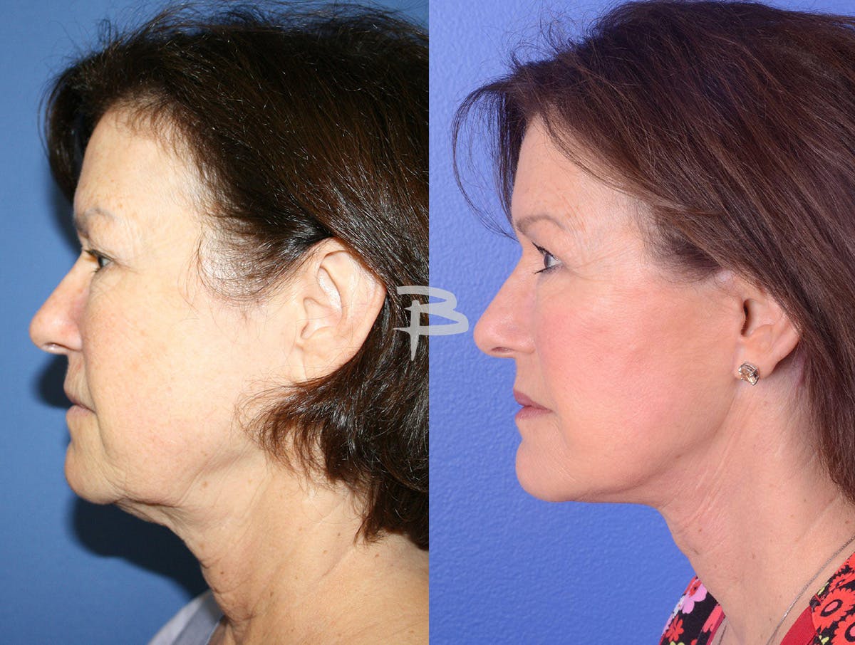 Facelift Before & After Gallery - Patient 118800 - Image 3