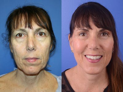 Facelift Before & After Gallery - Patient 386533 - Image 1