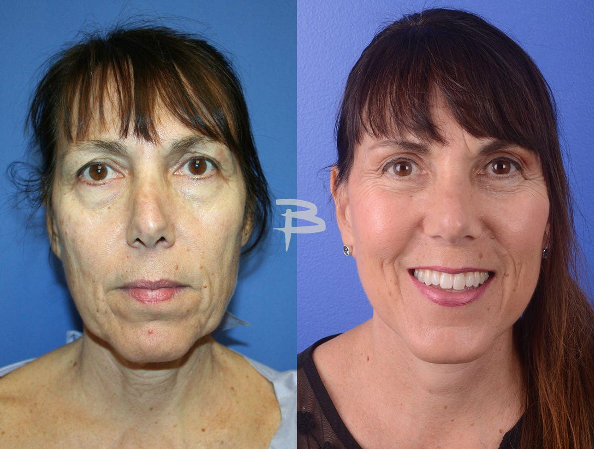 Facelift Before & After Gallery - Patient 386533 - Image 1