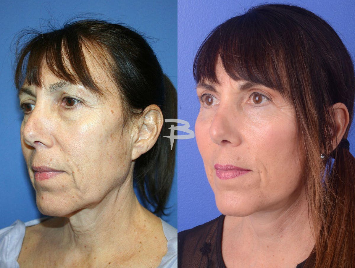 Facelift Before & After Gallery - Patient 386533 - Image 2