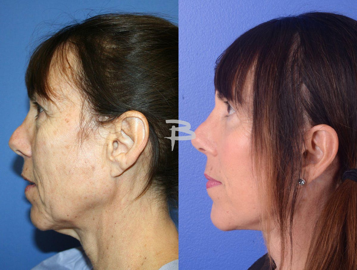Facelift Before & After Gallery - Patient 386533 - Image 3