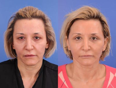 Facelift Before & After Gallery - Patient 253306 - Image 1