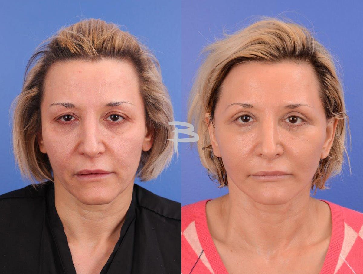 Facelift Before & After Gallery - Patient 283420 - Image 1