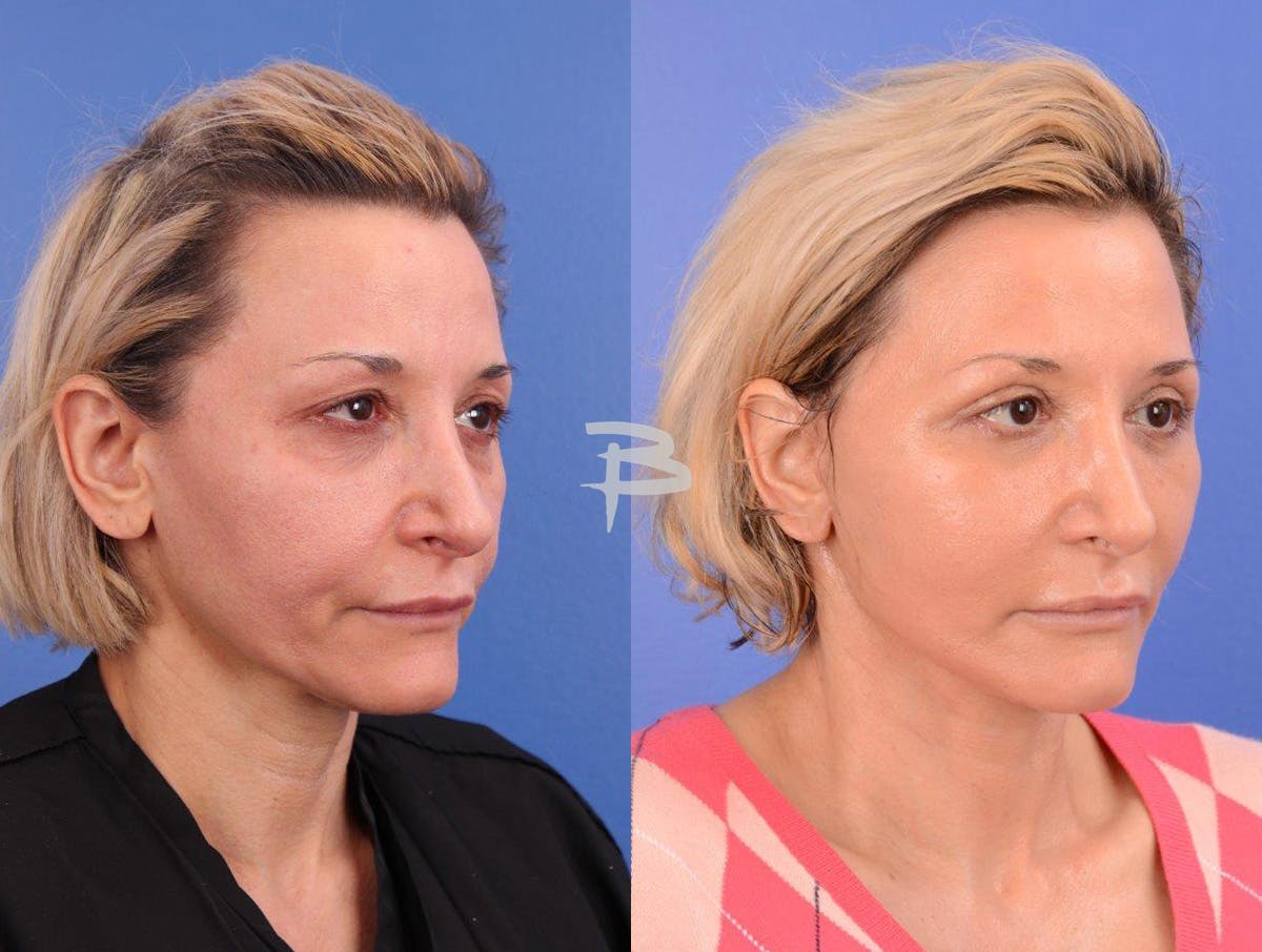 Facelift Before & After Gallery - Patient 283420 - Image 2