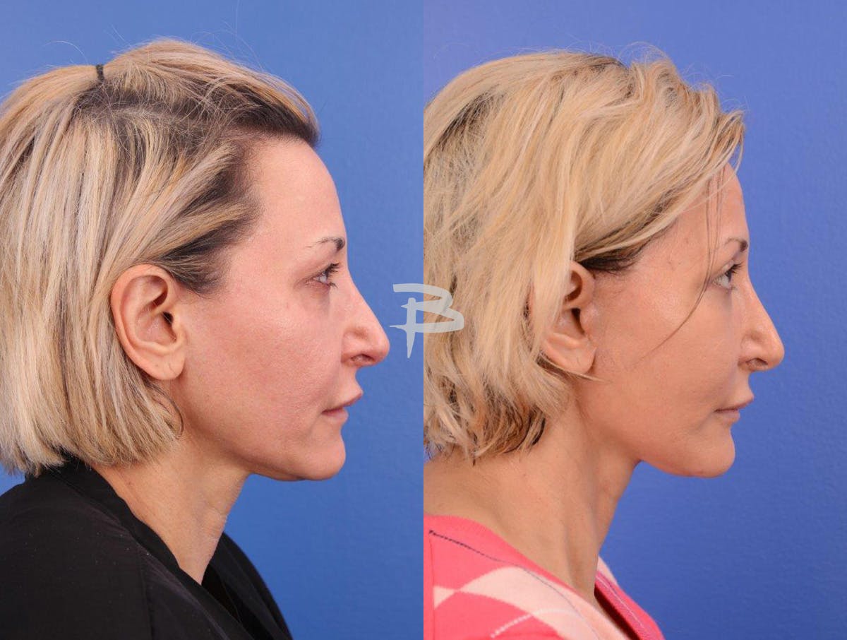 Facelift Before & After Gallery - Patient 283420 - Image 3