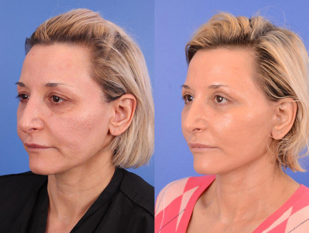 Recovery Before & After Gallery - Patient 724763 - Image 4