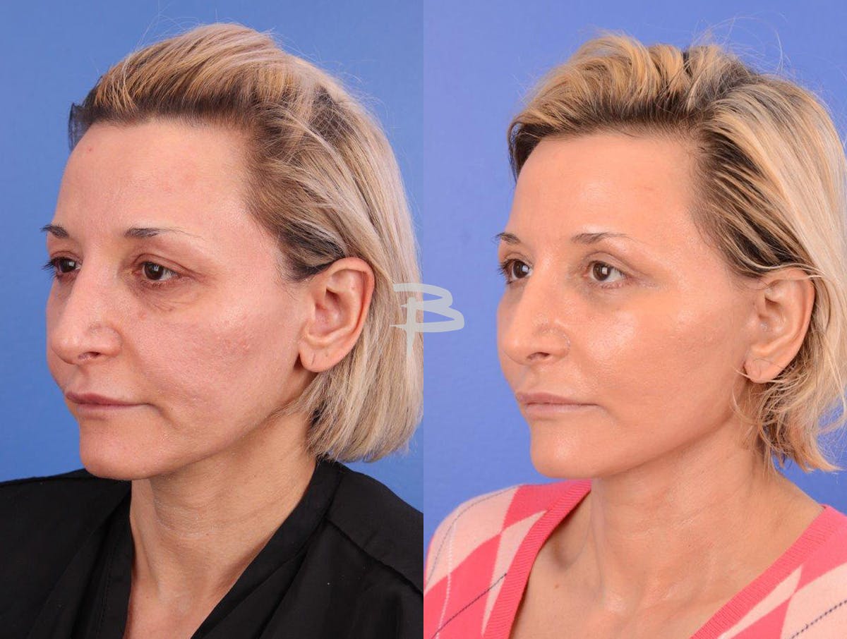 Facelift Before & After Gallery - Patient 283420 - Image 4