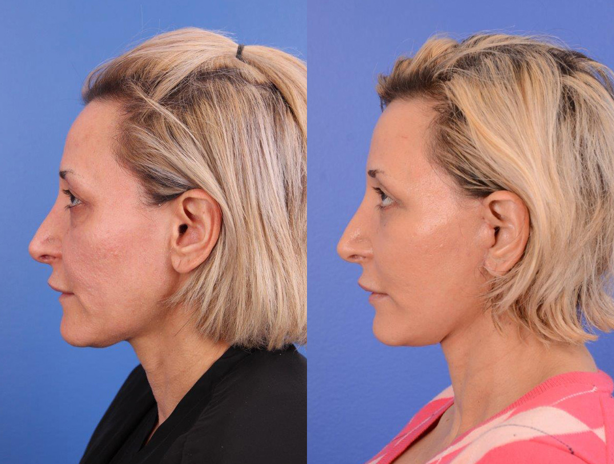 Recovery Before & After Gallery - Patient 724763 - Image 5