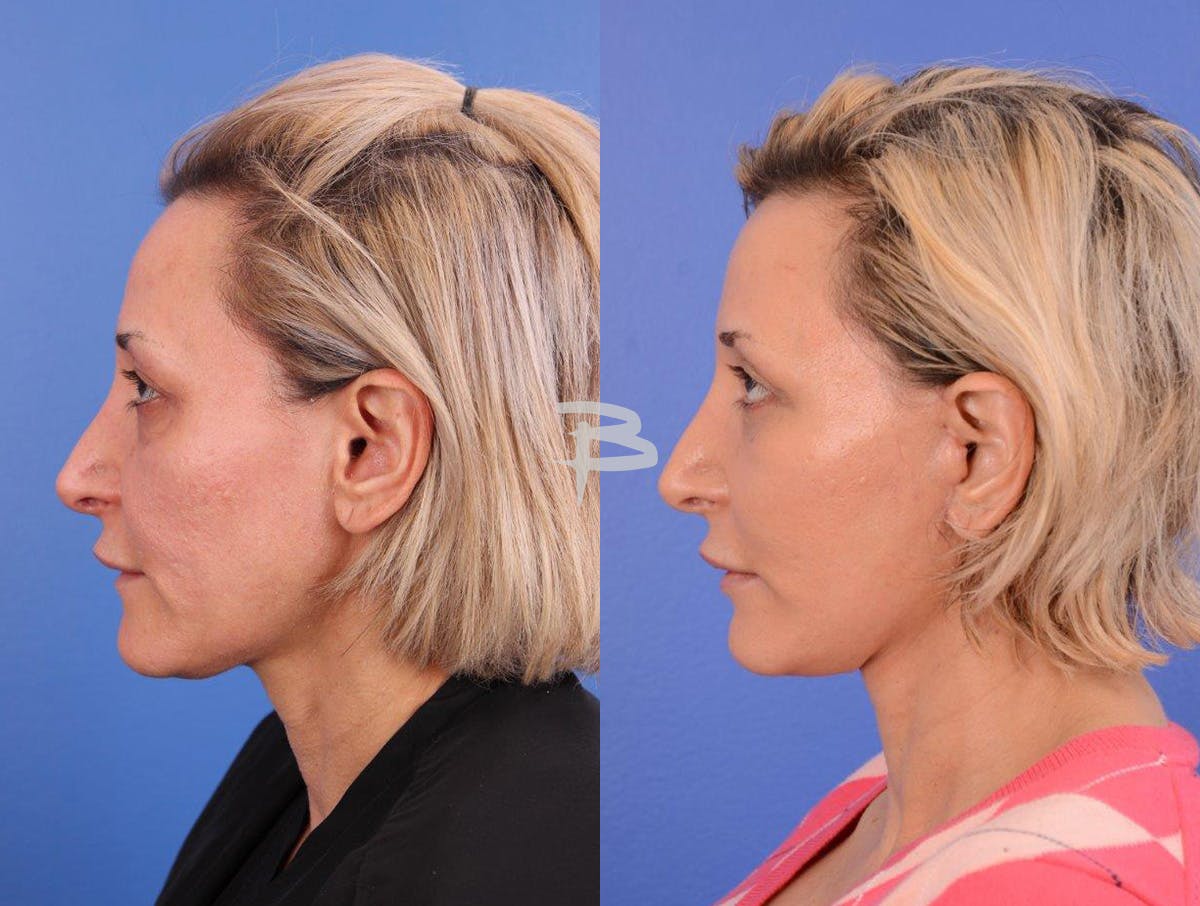 Facelift Before & After Gallery - Patient 283420 - Image 5
