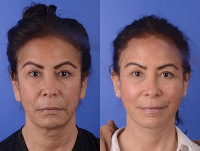 Facelift Before & After Gallery - Patient 423203 - Image 1