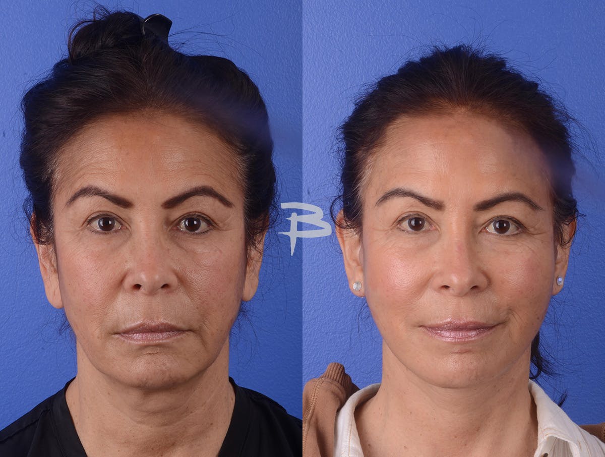 Facelift Before & After Gallery - Patient 423203 - Image 1