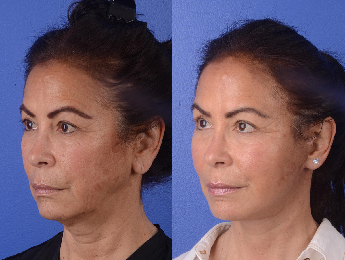 Facelift Before & After Gallery - Patient 423203 - Image 2