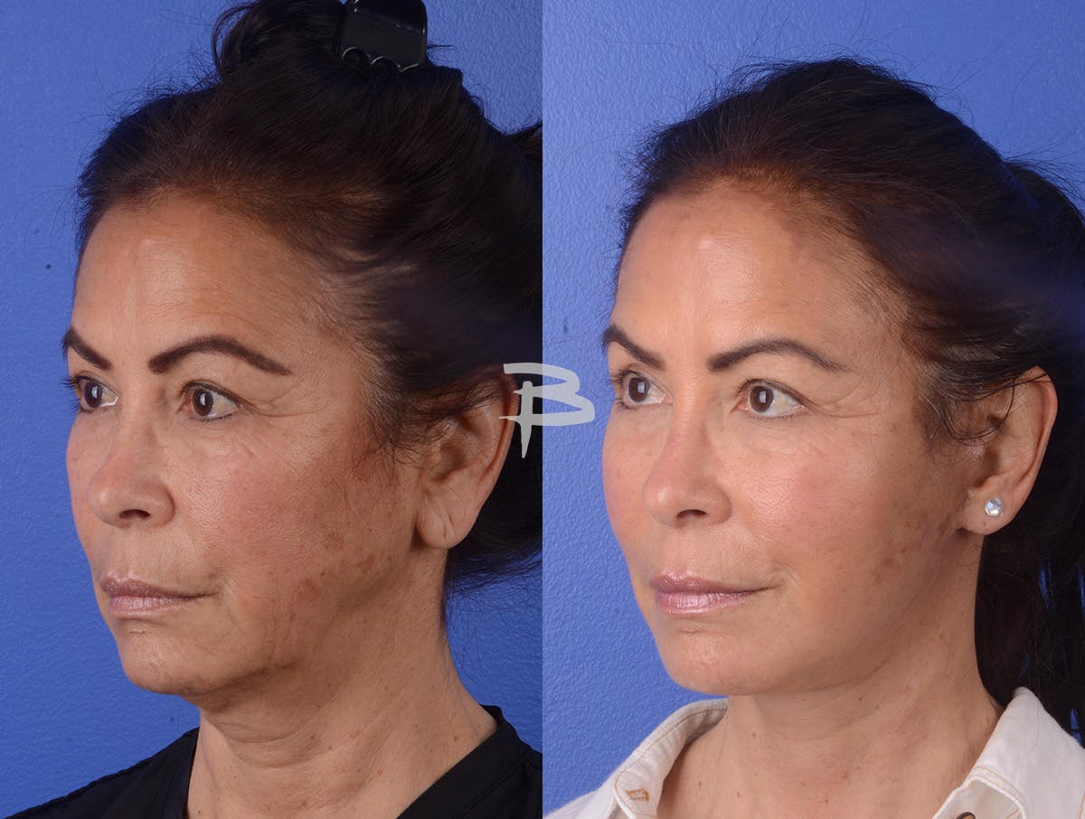Facelift Before & After Gallery - Patient 423203 - Image 2