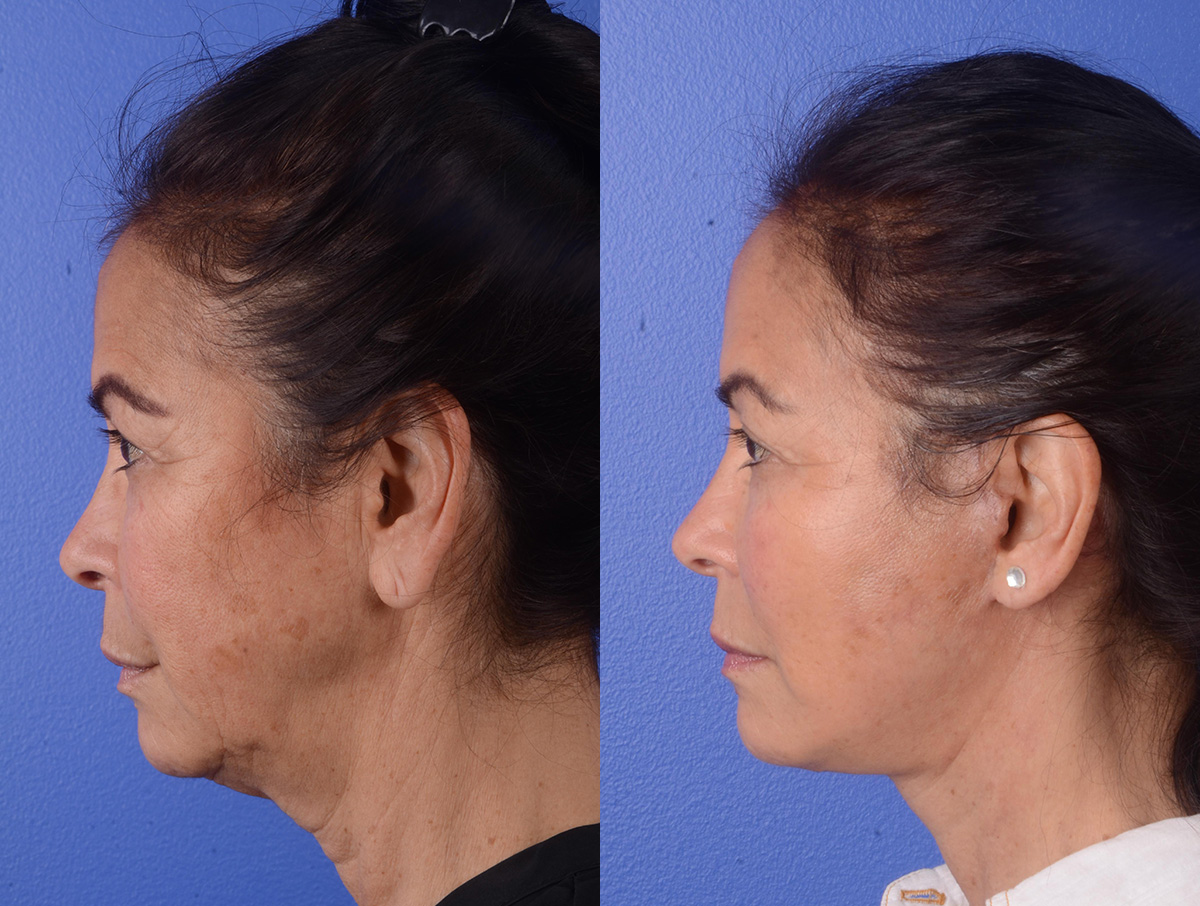 Facelift Before & After Gallery - Patient 423203 - Image 3